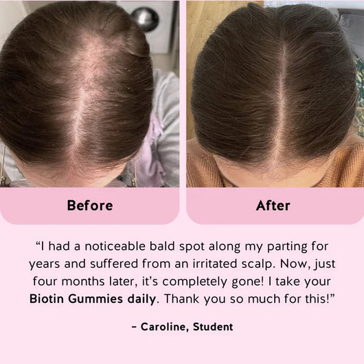 Nurvana Hair Growth Gummies